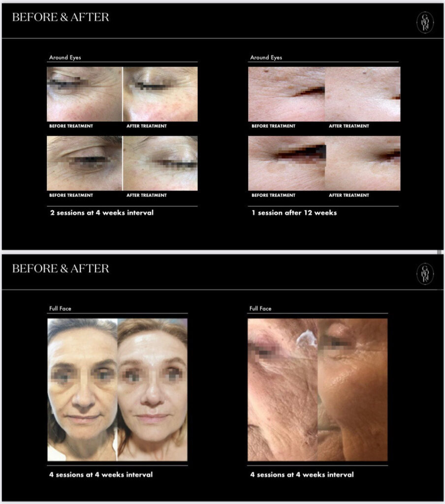 before & after, gouri treatment, refine,  wrinkles, fine line, anti-aging, injectable